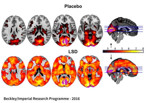 MRI of Brain on LSD